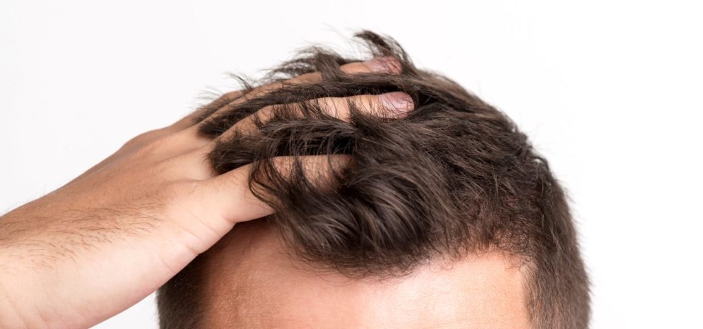 2567522 hair loss